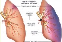 Мкб тромбоэмболия легочной артерии Хроническая тэла код по мкб 10