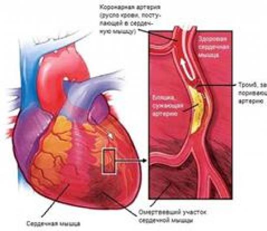 Ишемическая болезнь сердца — симптомы