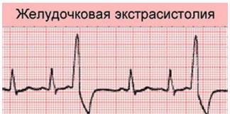 Sarežģītas funkcionālas ekstrasistoles: kas palīdzēs pret negaidītām sirds problēmām Neregulārs sirds ritms, piemēram, ekstrasistoles