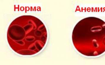 Anemia sa mga bata Ang bata ay may iron deficiency anemia 2 taon