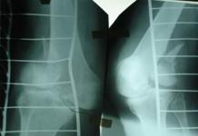 “Pengendalian Kerusakan” dalam pengobatan patah tulang pada pasien politrauma kritis Berita tentang Penerapan praktis konsep “pengendalian kerusakan” dalam pengobatan