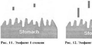 Endoskopski znaki hiatalne kile Z linija požiralnika