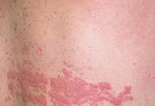 Signs of shingles and methods of treatment What shingles looks like on the body