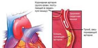 कोरोनरी हृदय रोग - लक्षण