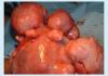 Fibroid uterus multipel