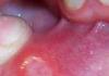 อาการของโรคปากเปื่อย อาการของปากเปื่อยและวิธีการรักษา