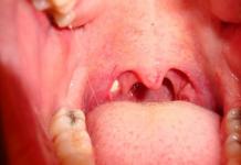 Hronisks tonsilīts un tā paasinājumi Lēni tonsilīta simptomi