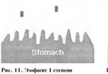 Endoskopiskās barības vada hiatal trūces Z līnijas pazīmes