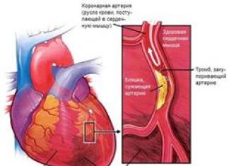 Koronárna choroba srdca - príznaky