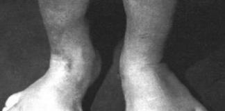 Sindromul Proteus: simptome și tratament Sindromul Proteus și tratamentul acestuia