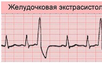 Непростые функциональные экстрасистолы: что поможет от неожиданных проблем с сердцем Нарушение сердечного ритма по типу экстрасистолии
