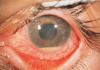 Macular edema ng retina