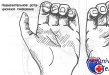 Liječenje zatvorenih prijeloma falangi prstiju Povrede proksimalnog interfalangealnog zgloba