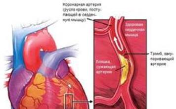 Koronarna srčna bolezen - simptomi