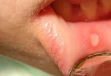 التهاب الفم القلاعي المزمن المتكرر - الأسباب والأعراض والعلاج التهاب الفم القلاعي المزمن المتكرر بوروفسكي