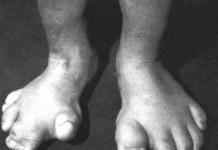 Proteus syndrome: sintomas at paggamot Proteus syndrome at paggamot nito