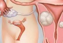 Fibroid rahim - penyebab dan gejala penyakit, diagnosis, metode pengobatan dan pencegahan Kemungkinan kehamilan dengan fibroid