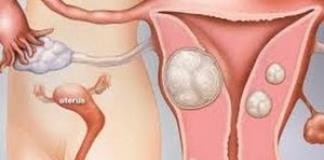 Маточни фиброиди - причини и симптоми на заболяването, диагностика, методи на лечение и профилактика Възможност за бременност с миома