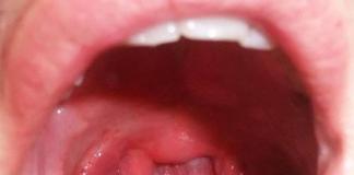 Adenoidi u nosu djeteta: znakovi i liječenje