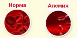 Анемия при деца Дете има желязодефицитна анемия от 2 години