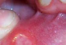 أعراض التهاب الفم أعراض التهاب الفم وكيفية علاجه