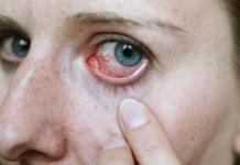 Panganib mula sa retinal hemorrhage sa retina at mga tampok ng pagpapakita nito Retinal hemorrhage treatment